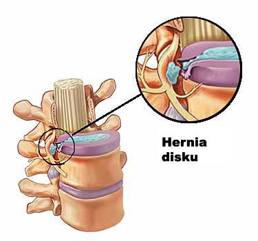 Hernia disku