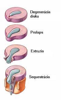 Hernia disku