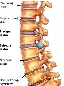 Hernia disku